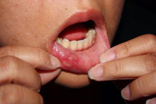 Herpes na usni i oralni seks